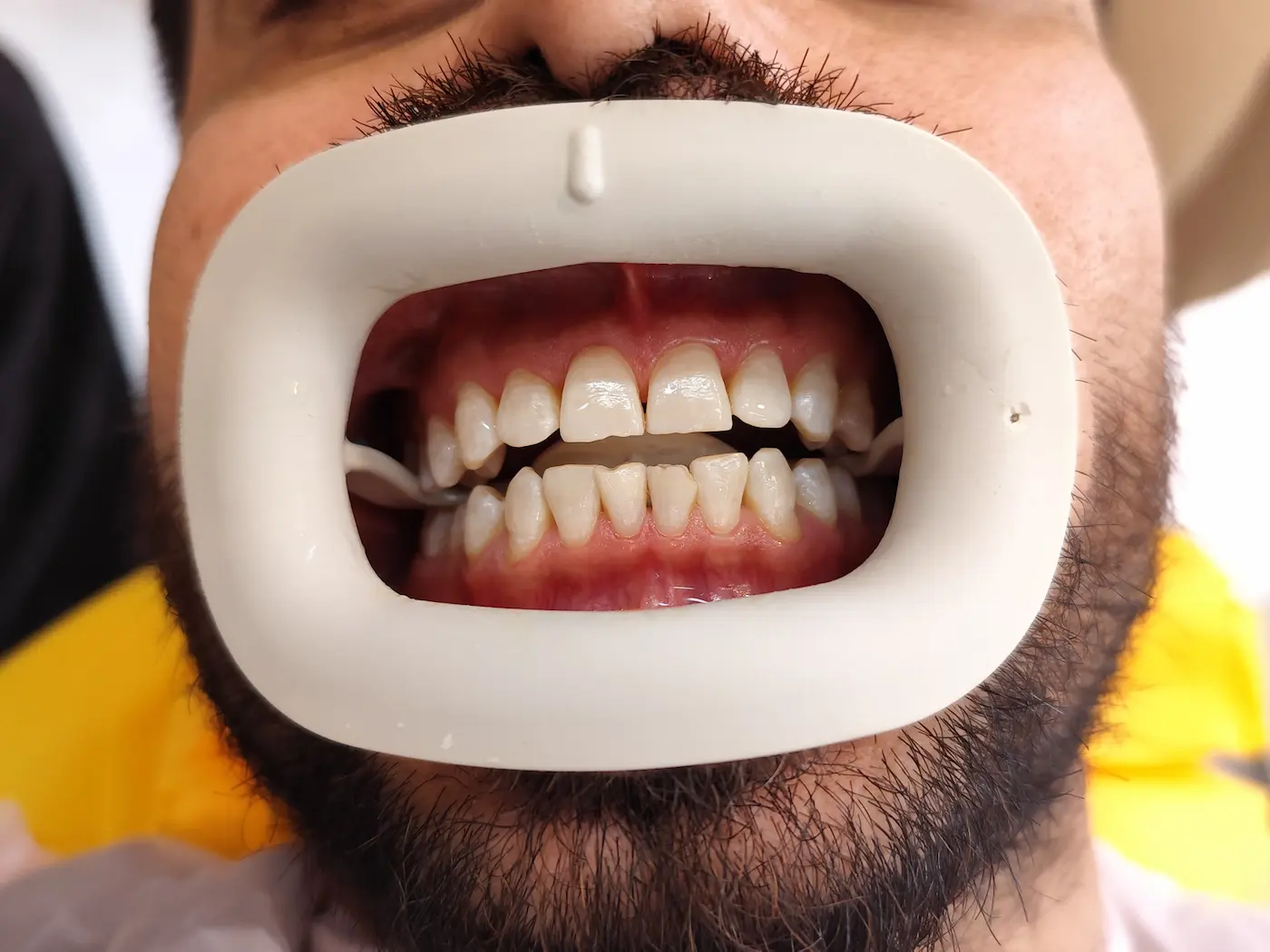 سفید کردن دندان یا بلیچینگ در کلینیک دندانپزشکی پارسیان جنوب تهران