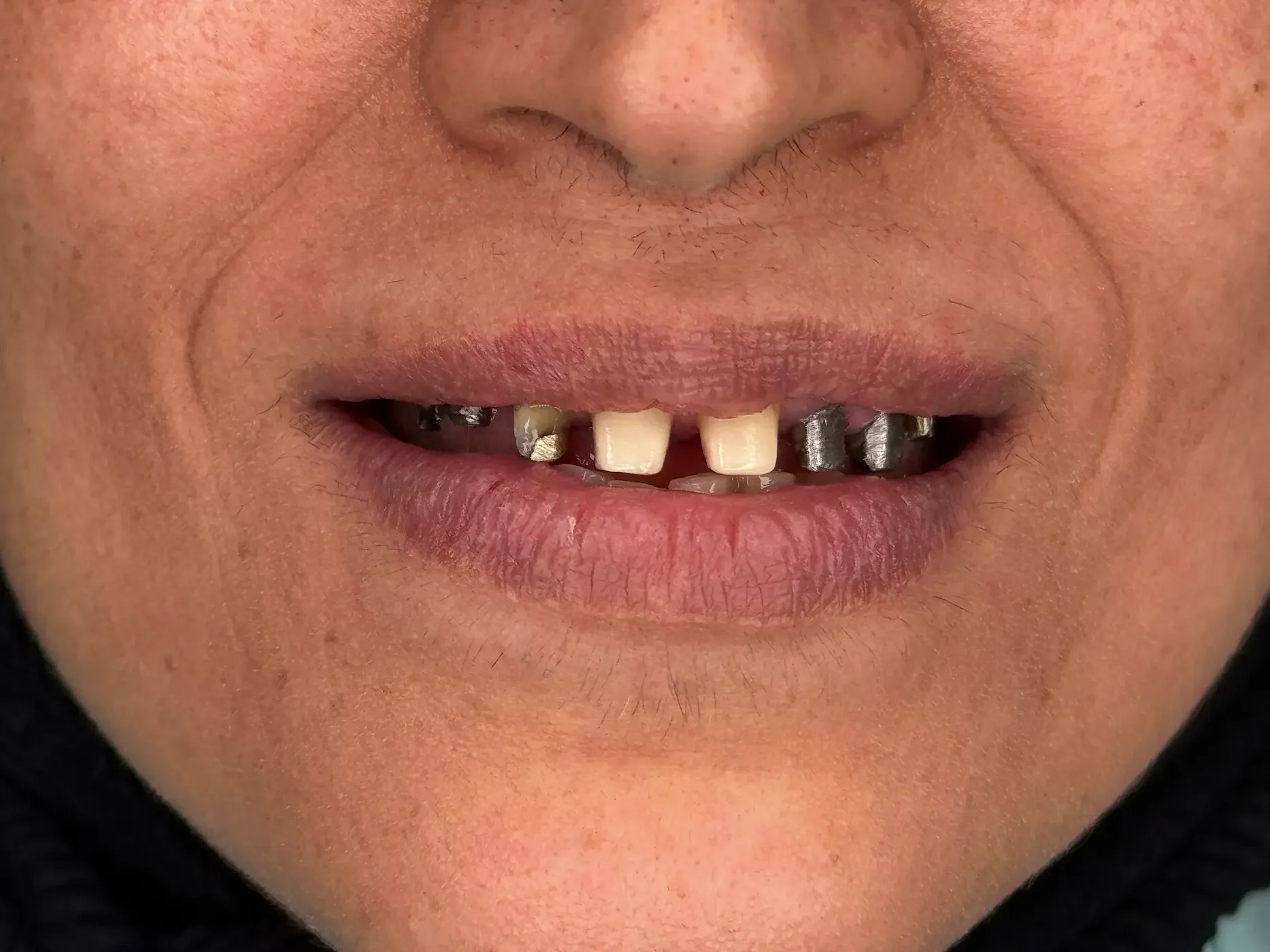 جراحی و نصب ایمپلنت دیجیتال در دندانپزشکی پارسیان نازی آباد